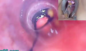 Grown-up Unshaded Peehole Endoscope Camera anent Bladder with Balls