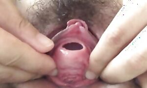 Anal stick insertion come by a difficulty urethra